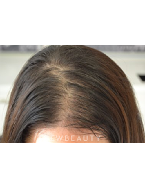 Dr. Julie Russak - Hair Loss Treatment - Before
