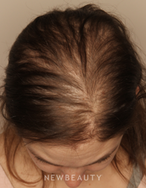 Dr. Doris Day - Hair Loss Treatment - Before