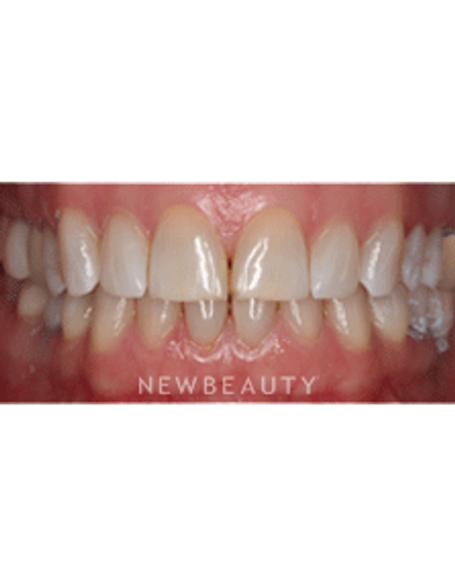 Dr. Neal Patel Smile Makeover - Before