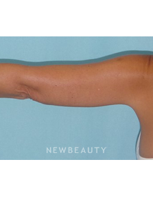 Dr. Sean Simon - Smartlipo - After