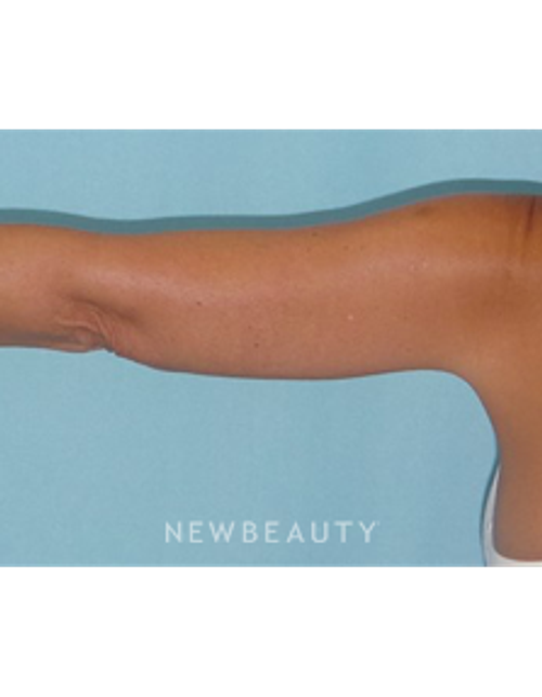 Dr. Sean Simon - Smartlipo - After