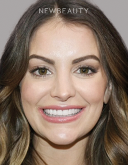 Dr. Salvator La Mastra - Smile Makeover -46108841 - After