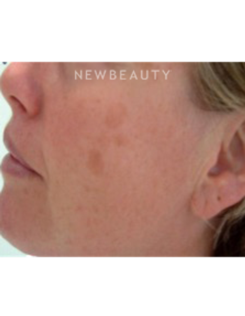 Dr. Marina Peredo - Lasers - Before