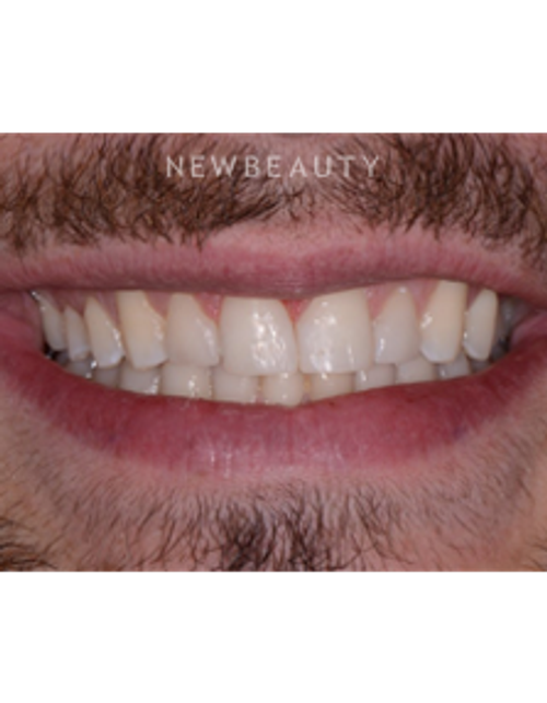 Dr. Irene Grafman - Dental Bonging - After