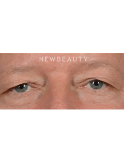 Dr. Jeffrey B. Wise - Upper Blepharoplasty - Before