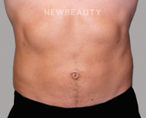 Dr. Sanjay Grover - Liposuction - 49728179 - After