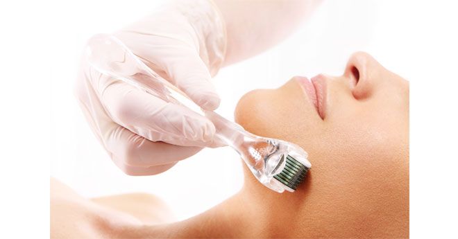microneedling