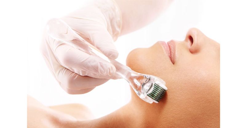 microneedling