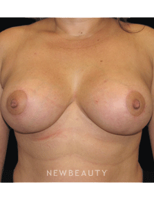 Dr. Sean Simon Breast Augmentation, Breast Lift - After