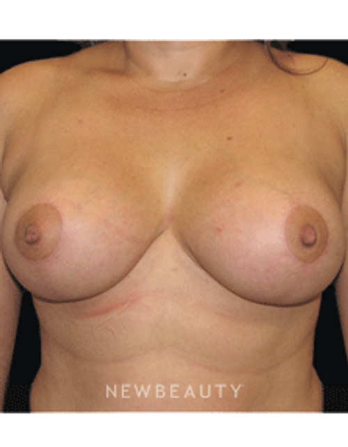 Dr. Sean Simon Breast Augmentation, Breast Lift - After