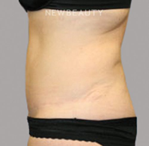 Dr. Christine Hamori - Tummy Tuck - After
