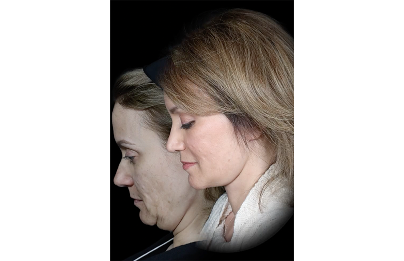 before and after necklift