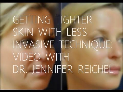 Dr. Reichel – Non-Invasive Skin Tightening and Lifting: Ultherapy