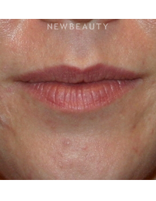 Dr. Kelly Bomer - Lip Enhancement - Before