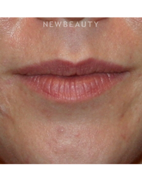 Dr. Kelly Bomer - Lip Enhancement - Before