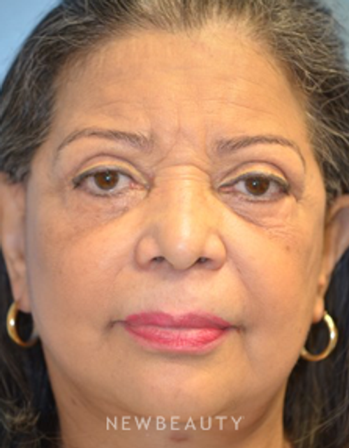 Dr. Aviva Preminger - Facelift - After