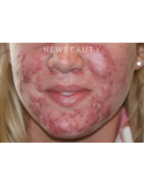 Dr. Marina Peredo - Acutane - Before