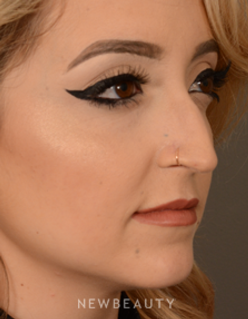 Dr. David Kim - Rhinoplasty - Before
