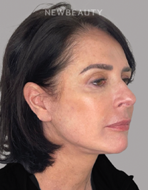 Dr. Dilip Madnani - Facelift -  45284120 - After