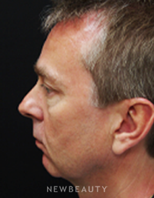 Dr. Mokhtar Asaadi Eyelid Lift, Facelift, Necklift - Before