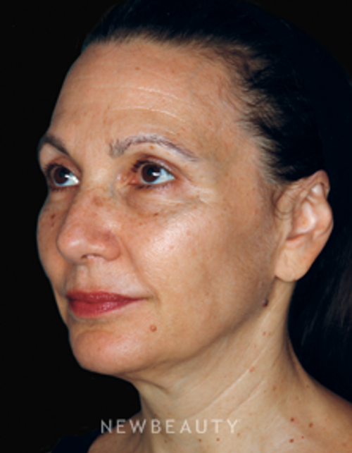 Dr. Doris Day - Injectables & Fillers - After