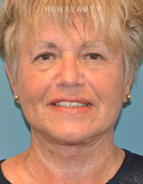 Dr. Alan Durkin - Limited Incision Facelift - After