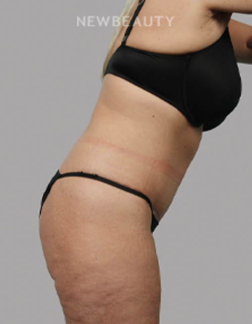 Dr. Michael McNeel - Tightening Transformation - 44726082 - After