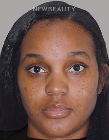 Dr. Anthony Bared - Rhinoplasty - 46164771 - Before