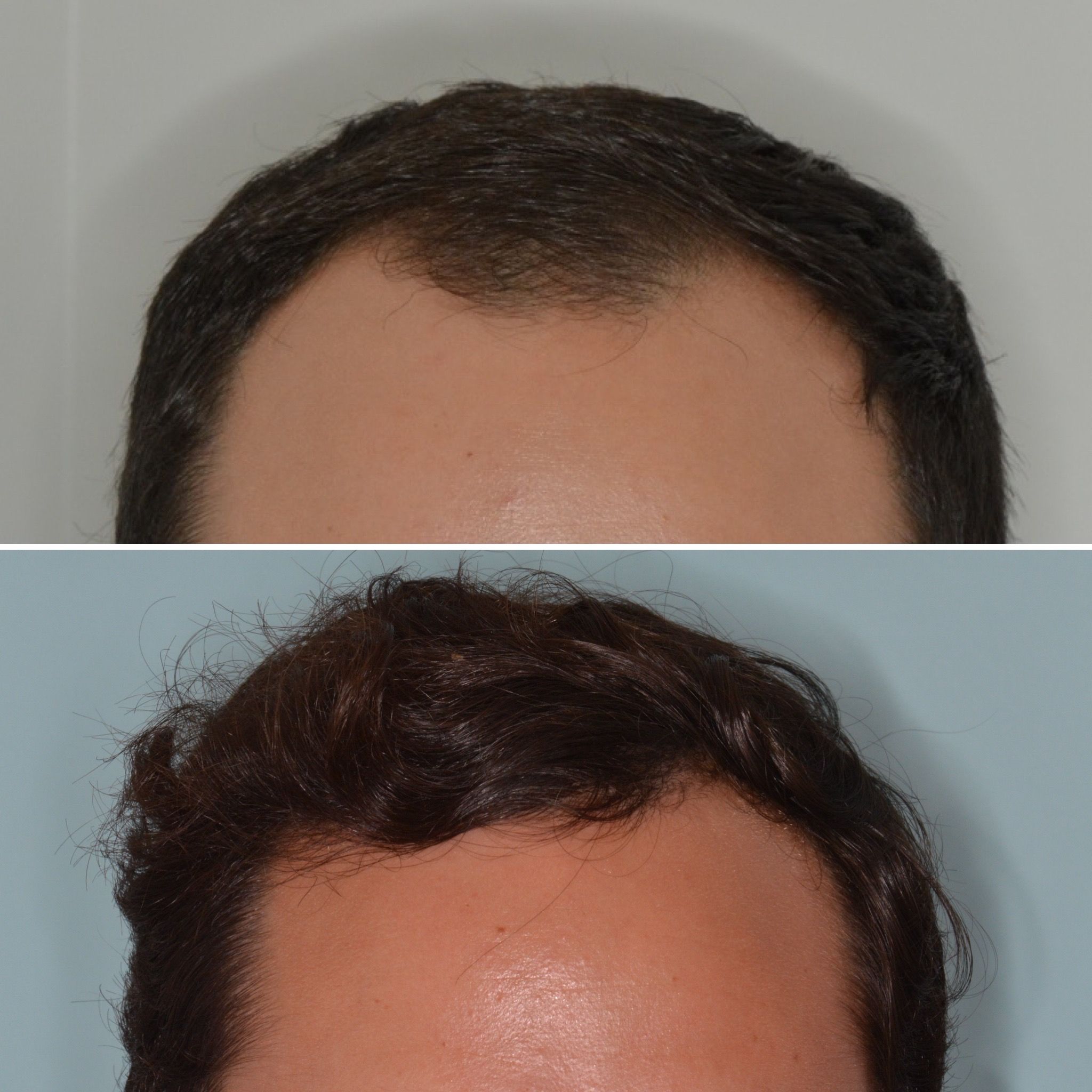 Miami hair restoration surgeon Anthony Bared, MD