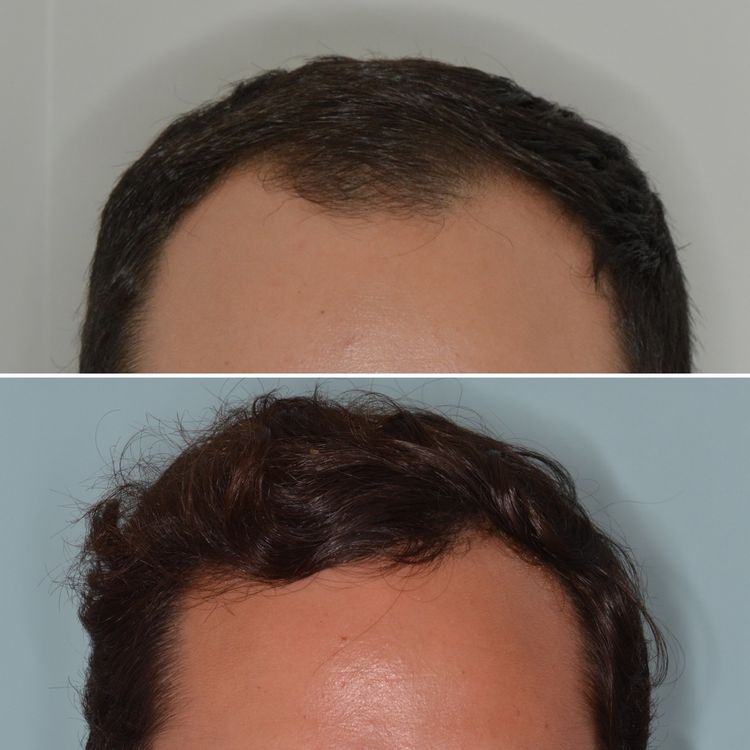 Miami hair restoration surgeon Anthony Bared, MD