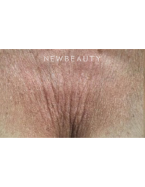 Dr. Marina Peredo - Ulthera - Before