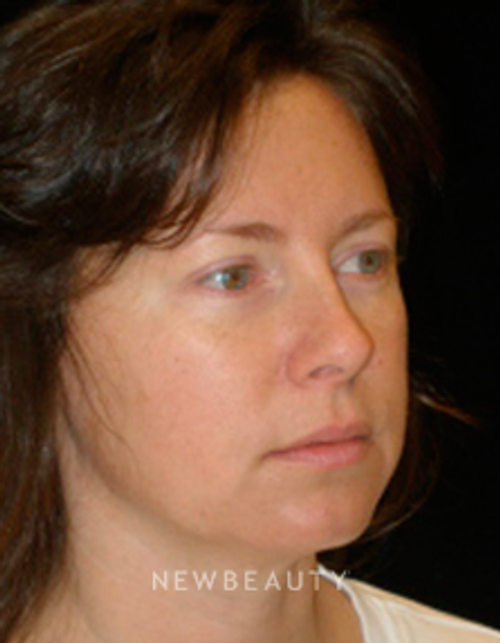 Dr. Phillip Chang Facelift, Eyelift, Lip Augmentation - Before