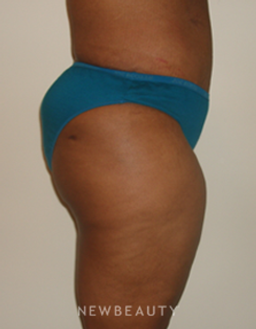 Dr. Michael Horn Tummy Tuck, Liposuction - After