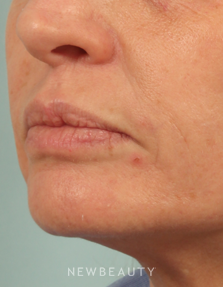 Dr. Kenneth Beer Injectables & Fillers, Juvederm - After