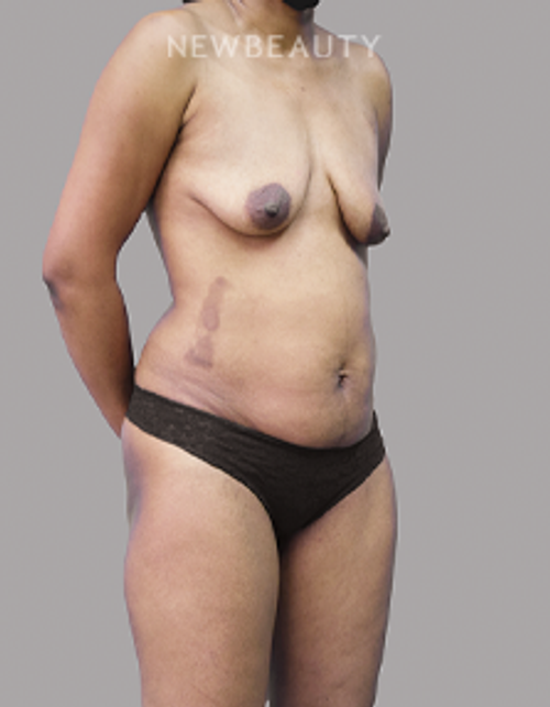 Dr. Olga Bachilo - Mommy Makeover - 28651905 - Before