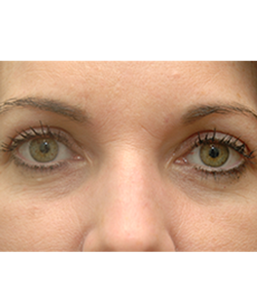 Dr. Jeffrey B. Wise - Eyelift - After