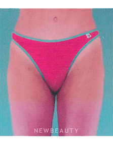 Dr. Henry Mentz Tummy Tuck, Liposuction - After