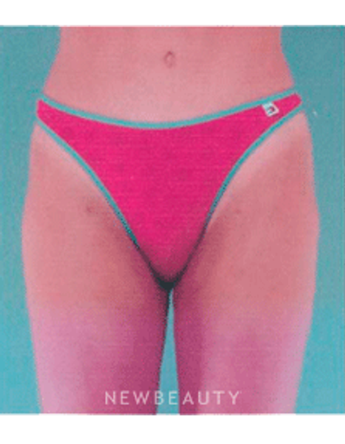 Dr. Henry Mentz Tummy Tuck, Liposuction - After