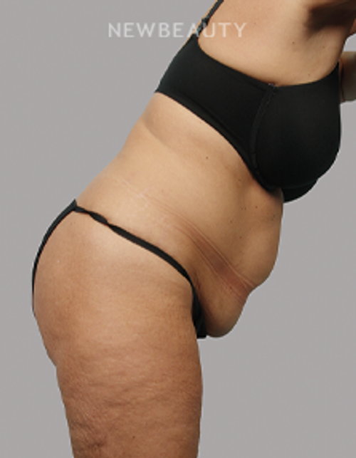 Dr. Michael McNeel - Tightening Transformation - 44726082 - Before