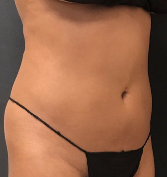 Dr. Janet Allenby - CoolSculpting - After