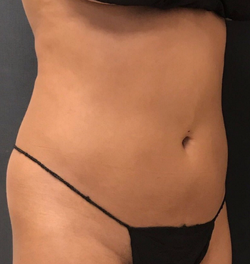 Dr. Janet Allenby - CoolSculpting - After