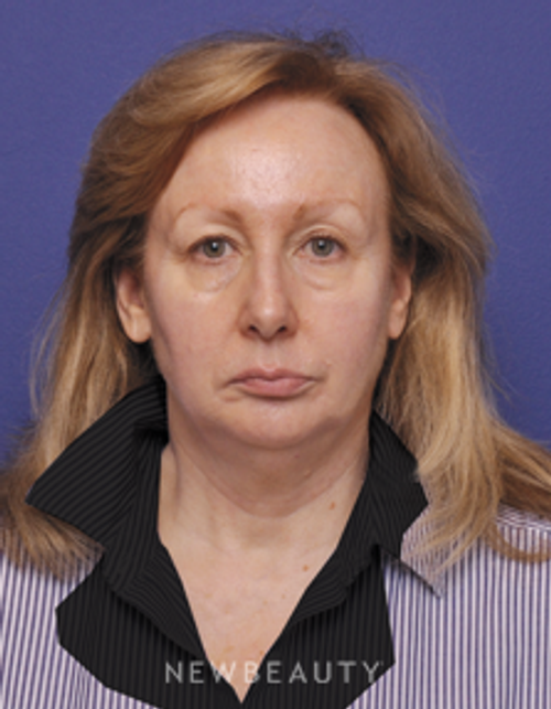Dr. Alan Durkin Facelift, Blepharoplasty - Before