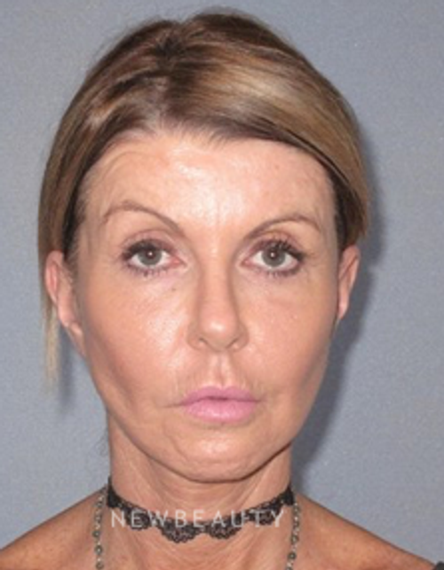 Dr. German Newall - Lower Bleph - After