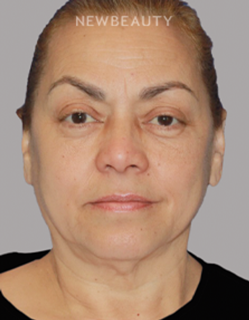 Dr. Konstantin Vasyukevich – Necklift and Facelift – 51896918 - Before