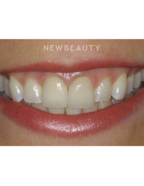 Dr. Joe Kravitz - Smile Makeover - After