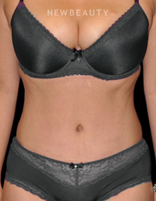 Dr. Bryan W. Gawley - Full Tummy Tuck - After