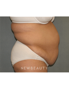 Dr Sean Simon Tummy Tuck, Lipo - Before
