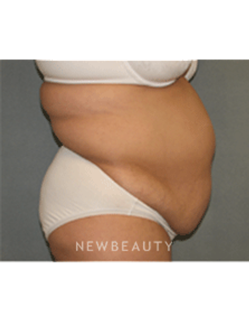 Dr Sean Simon Tummy Tuck, Lipo - Before