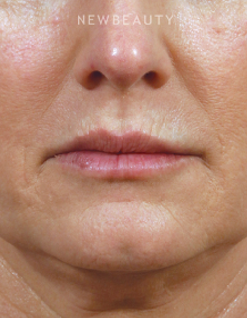 Dr. Kenneth Beer - Lip Filler - Before