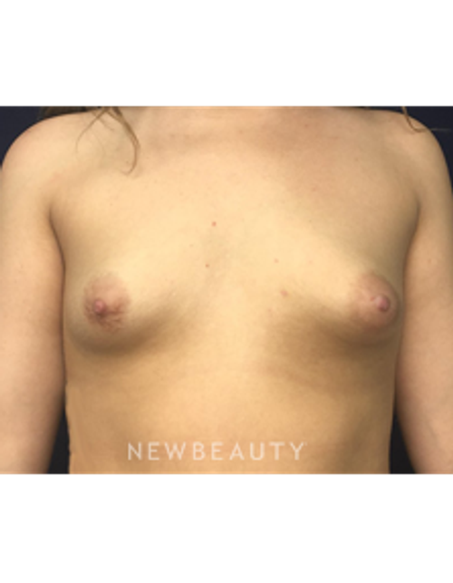 Dr. Kirk Churukian - Breast Augmentation - Before
